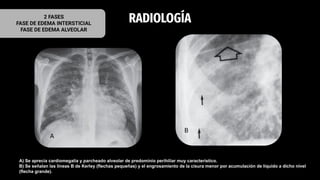 RADIOLOGÍA
2 FASES
FASE DE EDEMA INTERSTICIAL
FASE DE EDEMA ALVEOLAR
A
B
A) Se aprecia cardiomegalia y parcheado alveolar de predominio perihiliar muy característico.
B) Se señalan las líneas B de Kerley (flechas pequeñas) y el engrosamiento de la cisura menor por acumulación de líquido a dicho nivel
(flecha grande).
 