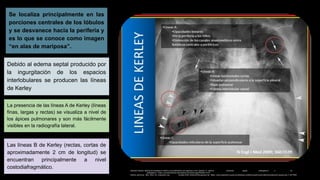 Se localiza principalmente en las
porciones centrales de los lóbulos
y se desvanece hacia la periferia y
es lo que se conoce como imagen
“en alas de mariposa”.
Debido al edema septal producido por
la ingurgitación de los espacios
interlobulares se producen las líneas
de Kerley
La presencia de las líneas A de Kerley (líneas
finas, largas y rectas) se visualiza a nivel de
los ápices pulmonares y son más fácilmente
visibles en la radiografía lateral.
Las líneas B de Kerley (rectas, cortas de
aproximadamente 2 cm de longitud) se
encuentran principalmente a nivel
costodiafragmático. Salvador Zubirán. Manual de terapéutica médica y procedimientos de urgencias, 6 ed. Capítulo 17: Edema pulmonar agudo cardiogénico y no
cardiogénico. https:/ accessmedicina.mhmedical.com/book.aspx?bookid=1479
Edema pulmonar. Myo Clinic. En: mayoclinic.org Octubre 2020. [Internet] Recuperado de: https:/ www.mayoclinic.org/es-es/diseases-conditions/pulmonary-edema/symptoms-causes/syc-2 0377009
 