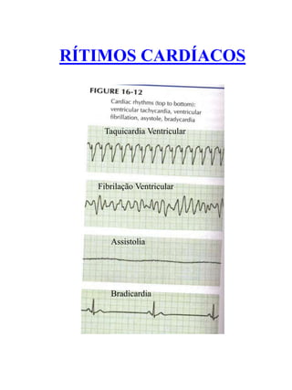 RÍTIMOS CARDÍACOS
Taquicardia Ventricular
Fibrilação Ventricular
Assistolia
Bradicardia
 