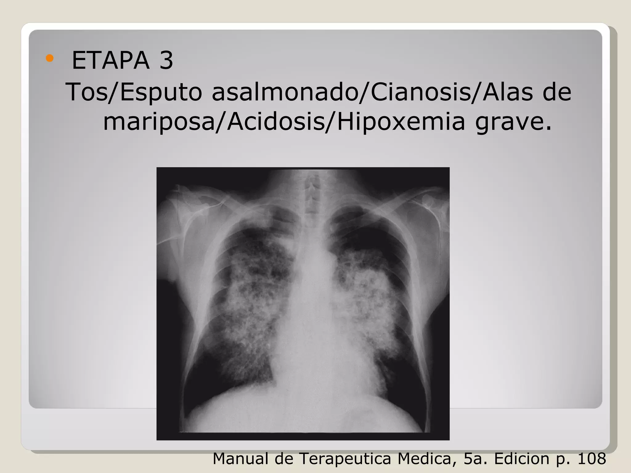  ETAPA 3
Tos/Esputo asalmonado/Cianosis/Alas de
mariposa/Acidosis/Hipoxemia grave.
Manual de Terapeutica Medica, 5a. Edicion p. 108