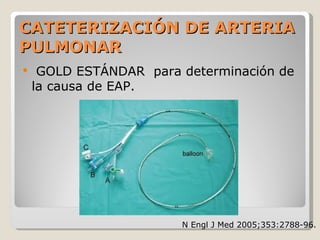 CATETERIZACIÓN DE ARTERIACATETERIZACIÓN DE ARTERIA
PULMONARPULMONAR
 GOLD ESTÁNDAR para determinación de
la causa de EAP.
N Engl J Med 2005;353:2788-96.
 