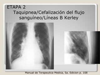 ETAPA 2
Taquipnea/Cefalización del flujo
sanguíneo/Líneas B Kerley
Manual de Terapeutica Medica, 5a. Edicion p. 108
 