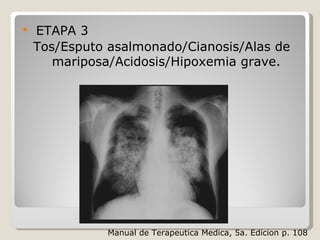  ETAPA 3
Tos/Esputo asalmonado/Cianosis/Alas de
mariposa/Acidosis/Hipoxemia grave.
Manual de Terapeutica Medica, 5a. Edicion p. 108
 
