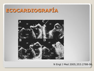 ECOCARDIOGRAFÍAECOCARDIOGRAFÍA
N Engl J Med 2005;353:2788-96.
 