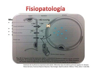 Mecanismos de producción de edema 
• Alteraciones del equilibrio entre presión 
hidrostatica y presión oncotica. 
• Defectos de la permeabilidad capilar. 
• Insuficiencia del drenaje venoso. 
• Lesion de membrana alveolar. 
 Inflamación 
 Irritantes químicos 
 Físicos 
 Humos 
Síndrome de insuficiencia respiratoria del adulto. Diferentes tipos de edema pulmonar agudo. En: Octavio 
Rivera Serrano, Francisco Navarro Reynoso. Neumología. Séptima edición. México: Trillas; 2011. P. 326-340. 
 