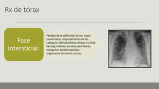 Rx de tórax
Fase
intersticial:
Pérdida de la definición de los vasos
pulmonares, engrosamiento de los
tabiques interlobulillares (líneas A y B de
Kerley), nódulos acinares perhiliares,
manguitos peribronquiales,
engrosamiento de las cisuras.
 