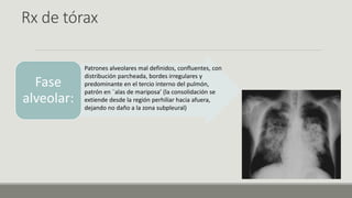 Rx de tórax
Fase
alveolar:
Patrones alveolares mal definidos, confluentes, con
distribución parcheada, bordes irregulares y
predominante en el tercio interno del pulmón,
patrón en ¨alas de mariposa’ (la consolidación se
extiende desde la región perhiliar hacia afuera,
dejando no daño a la zona subpleural)
 