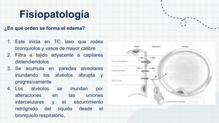 ¿En qué orden se forma el edema?
1. Este inicia en TC laxo que rodea
bronquiolos y vasos de mayor calibre
2. Filtra a tejido adyacente a capilares
distendiendolos
3. Se acumula en paredes alveolares
inundando los alvéolos abrupta y
progresivamente
4. Los alvéolos se inundan por
alteraciones en las uniones
intercelulares y el escurrimiento
retrógrado del líquido desde el
bronquiolo respiratorio.
Fisiopatología
 