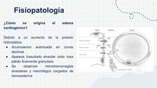 ¿Cómo se origina el edema
cardiogénico?
Debido a un aumento de la presión
hidrostática.
● Acumulacion acentuada en zonas
declives
● Aparece trasudado alveolar color rosa
pálido finamente granulado
● Se observan microhemorragias
alveolares y macrofagos cargados de
hemosiderina
Fisiopatología
 