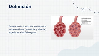 Presencia de líquido en los espacios
extravasculares (intersticial y alveolar)
superiores a las fisiológicas.
Definición
 