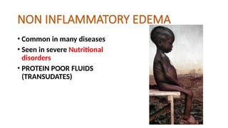 NON INFLAMMATORY EDEMA
• Common in many diseases
• Seen in severe Nutritional
disorders
• PROTEIN POOR FLUIDS
(TRANSUDATES)
 