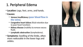 1. Peripheral Edema
• Location: Legs, feet, arms, and hands.
• Causes:
• Venous insufficiency (poor blood flow in
the veins).
• Congestive heart failure (fluid retention due
to poor heart function).
• Kidney disease (inability to remove excess
fluid).
• Lymphatic obstruction (lymphedema).
• Symptoms: Swelling of the limbs, often
more noticeable in the lower legs and
ankles.
 