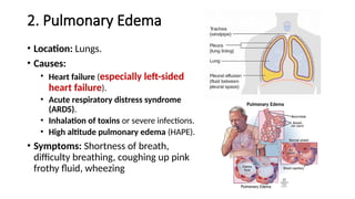 2. Pulmonary Edema
• Location: Lungs.
• Causes:
• Heart failure (especially left-sided
heart failure).
• Acute respiratory distress syndrome
(ARDS).
• Inhalation of toxins or severe infections.
• High altitude pulmonary edema (HAPE).
• Symptoms: Shortness of breath,
difficulty breathing, coughing up pink
frothy fluid, wheezing
 