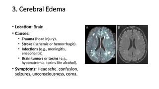 3. Cerebral Edema
• Location: Brain.
• Causes:
• Trauma (head injury).
• Stroke (ischemic or hemorrhagic).
• Infections (e.g., meningitis,
encephalitis).
• Brain tumors or toxins (e.g.,
hyponatremia, toxins like alcohol).
• Symptoms: Headache, confusion,
seizures, unconsciousness, coma.
 