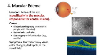 4. Macular Edema
• Location: Retina of the eye
(specifically in the macula,
responsible for central vision).
• Causes:
• Diabetic retinopathy (common in
people with diabetes).
• Retinal vein occlusion.
• Eye surgery or inflammation (e.g.,
uveitis).
• Symptoms: Blurred or wavy vision,
color changes, dark spots in the
visual field.
 
