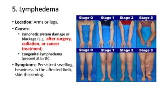 5. Lymphedema
• Location: Arms or legs.
• Causes:
• Lymphatic system damage or
blockage (e.g., after surgery,
radiation, or cancer
treatment).
• Congenital lymphedema
(present at birth).
• Symptoms: Persistent swelling,
heaviness in the affected limb,
skin thickening.
 