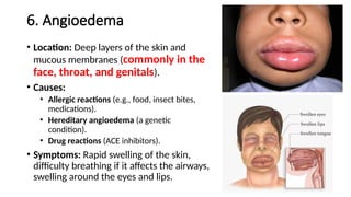6. Angioedema
• Location: Deep layers of the skin and
mucous membranes (commonly in the
face, throat, and genitals).
• Causes:
• Allergic reactions (e.g., food, insect bites,
medications).
• Hereditary angioedema (a genetic
condition).
• Drug reactions (ACE inhibitors).
• Symptoms: Rapid swelling of the skin,
difficulty breathing if it affects the airways,
swelling around the eyes and lips.
 