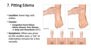 7. Pitting Edema
• Location: lower legs and
ankles.
• Causes:
• Congestive heart failure,
kidney disease, liver disease,
or deep vein thrombosis (DVT).
• Symptoms: When you press
on the swollen area, a "pit" or
indentation remains for a few
seconds.
 
