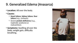 9. Generalized Edema (Anasarca)
• Location: All over the body.
• Causes:
• Heart failure, kidney failure, liver
failure (e.g., cirrhosis).
• Severe protein deficiency (e.g.,
nephrotic syndrome or
malnutrition).
• Symptoms: Swelling all over the
body, weight gain, difficulty
breathing.
 