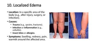 10. Localized Edema
• Location: In a specific area of the
body (e.g., after injury, surgery, or
infection).
• Causes:
• Trauma (e.g., sprains, fractures).
• Infection or inflammation (e.g.,
cellulitis).
• Insect bites or allergies.
• Symptoms: Swelling, redness, pain,
warmth around the affected area.
 