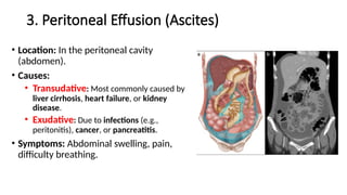 3. Peritoneal Effusion (Ascites)
• Location: In the peritoneal cavity
(abdomen).
• Causes:
• Transudative: Most commonly caused by
liver cirrhosis, heart failure, or kidney
disease.
• Exudative: Due to infections (e.g.,
peritonitis), cancer, or pancreatitis.
• Symptoms: Abdominal swelling, pain,
difficulty breathing.
 