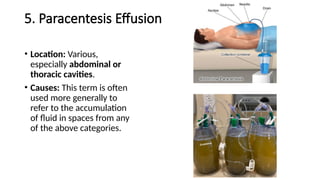 5. Paracentesis Effusion
• Location: Various,
especially abdominal or
thoracic cavities.
• Causes: This term is often
used more generally to
refer to the accumulation
of fluid in spaces from any
of the above categories.
 