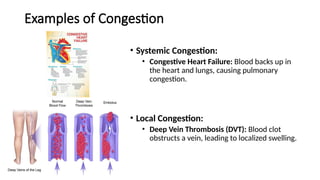 Examples of Congestion
• Systemic Congestion:
• Congestive Heart Failure: Blood backs up in
the heart and lungs, causing pulmonary
congestion.
• Local Congestion:
• Deep Vein Thrombosis (DVT): Blood clot
obstructs a vein, leading to localized swelling.
 