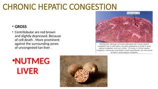 CHRONIC HEPATIC CONGESTION
• GROSS
• Centrilobular are red brown
and slightly depressed. Because
of cell death . More prominent
against the surrounding zones
of uncongested tan liver .
•NUTMEG
LIVER
 