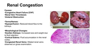 Renal Congestion
Causes:
•Congestive Heart Failure (CHF)
•Renal Vein Thrombosis
•Ureteral Obstruction
•Terms/Names:
•Hypoperfusion: Reduced blood flow to the
kidneys.
•Morphological Changes:
•Swollen Kidneys: Increased size and weight due
to fluid retention.
•Cortical Edema: Fluid accumulation in the renal
cortex.
•Congested Renal Veins: Dilated renal veins
observed on gross examination.
 