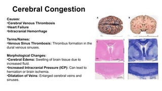 Cerebral Congestion
Causes:
•Cerebral Venous Thrombosis
•Heart Failure
•Intracranial Hemorrhage
Terms/Names:
•Venous Sinus Thrombosis: Thrombus formation in the
dural venous sinuses.
Morphological Changes:
•Cerebral Edema: Swelling of brain tissue due to
increased fluid.
•Increased Intracranial Pressure (ICP): Can lead to
herniation or brain ischemia.
•Dilatation of Veins: Enlarged cerebral veins and
sinuses.
 