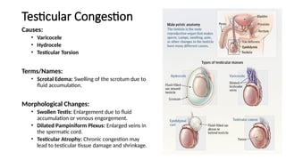 Testicular Congestion
Causes:
• Varicocele
• Hydrocele
• Testicular Torsion
Terms/Names:
• Scrotal Edema: Swelling of the scrotum due to
fluid accumulation.
Morphological Changes:
• Swollen Testis: Enlargement due to fluid
accumulation or venous engorgement.
• Dilated Pampiniform Plexus: Enlarged veins in
the spermatic cord.
• Testicular Atrophy: Chronic congestion may
lead to testicular tissue damage and shrinkage.
 