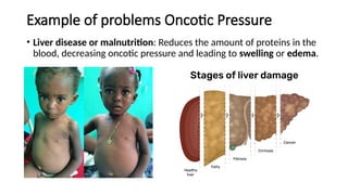 Example of problems Oncotic Pressure
• Liver disease or malnutrition: Reduces the amount of proteins in the
blood, decreasing oncotic pressure and leading to swelling or edema.
 