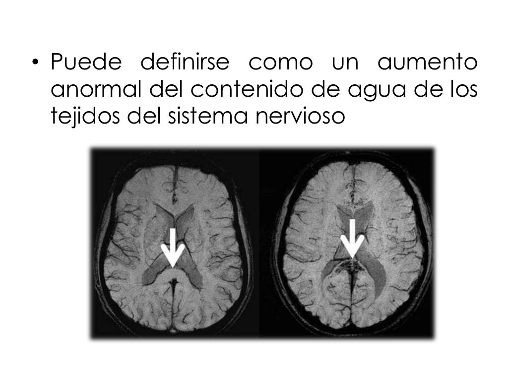 Edema cerebral