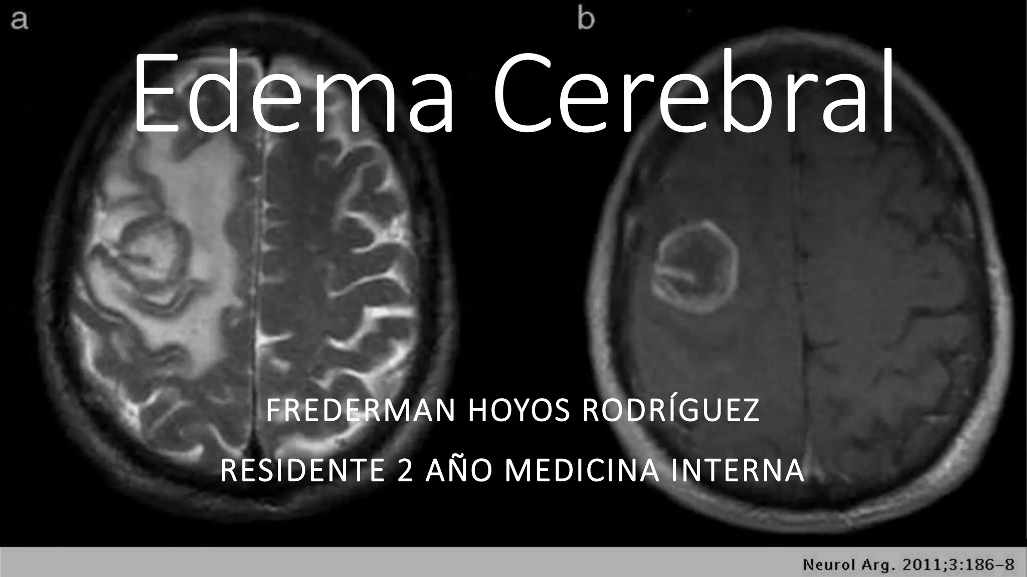 Edema cerebral | PPTX