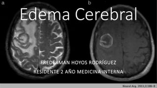 Edema Cerebral
FREDERMAN HOYOS RODRÍGUEZ
RESIDENTE 2 AÑO MEDICINA INTERNA
 