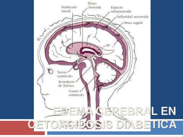 Edema cerebral en Cetoacidosis Diabetica en la poblacion Edema cerebral en Cetoacidosis Diabetica en la poblacion
