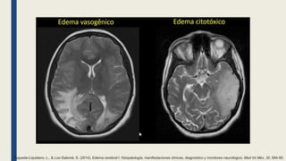 Esqueda-Liquidano, L., & Loo-Salomé, S. (2014). Edema cerebral I: fisiopatología, manifestaciones clínicas, diagnóstico y monitoreo neurológico. Med Int Méx, 30, 584-90.
 