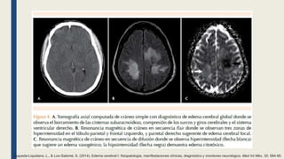 Esqueda-Liquidano, L., & Loo-Salomé, S. (2014). Edema cerebral I: fisiopatología, manifestaciones clínicas, diagnóstico y monitoreo neurológico. Med Int Méx, 30, 584-90.
 
