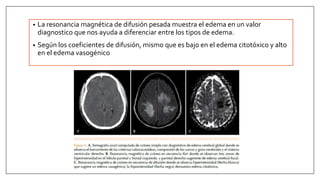 • La resonancia magnética de difusión pesada muestra el edema en un valor
diagnostico que nos ayuda a diferenciar entre los tipos de edema.
• Según los coeficientes de difusión, mismo que es bajo en el edema citotóxico y alto
en el edema vasogénico
 