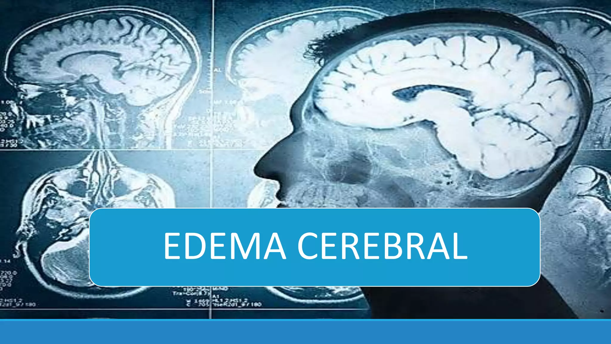 edema cerebral XD.pptx | Brain and Nervous System Disorders | Diseases ...