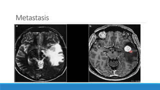 Metastasis
 