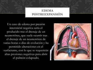 Un caso de edema por presión
intersticial negativa sería el
producido tras el drenaje de un
neumotórax, que suele ocurrir tras
el drenaje de un neumotórax de
varias horas o días de evolución y ha
permitido alteraciones en el
surfactante, con lo que se requerirán
altas presiones negativas para abrir
el pulmón colapsado.
EDEMA
POSTREEXPANSIÓN
 
