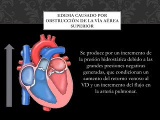 Se produce por un incremento de
la presión hidrostática debido a las
grandes presiones negativas
generadas, que condicionan un
aumento del retorno venoso al
VD y un incremento del flujo en
la arteria pulmonar.
EDEMA CAUSADO POR
OBSTRUCCIÓN DE LA VÍA AÉREA
SUPERIOR
 