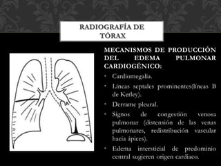 MECANISMOS DE PRODUCCIÓN
DEL EDEMA PULMONAR
CARDIOGÉNICO:
• Cardiomegalia.
• Líneas septales prominentes(líneas B
de Kerley).
• Derrame pleural.
• Signos de congestión venosa
pulmonar (distensión de las venas
pulmonares, redistribución vascular
hacia ápices).
• Edema intersticial de predominio
central sugieren origen cardiaco.
RADIOGRAFÍA DE
TÓRAX
 