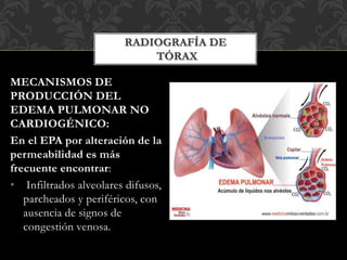 MECANISMOS DE
PRODUCCIÓN DEL
EDEMA PULMONAR NO
CARDIOGÉNICO:
En el EPA por alteración de la
permeabilidad es más
frecuente encontrar:
• Infiltrados alveolares difusos,
parcheados y periféricos, con
ausencia de signos de
congestión venosa.
RADIOGRAFÍA DE
TÓRAX
 
