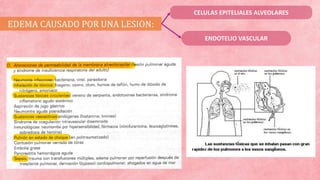 EDEMA CAUSADO POR UNA LESION:
ENDOTELIO VASCULAR
CELULAS EPITELIALES ALVEOLARES
 