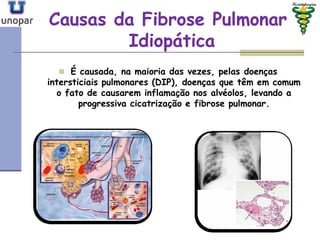 Causas da Fibrose PulmonarCausas da Fibrose Pulmonar
IdiopáticaIdiopática
 É causada, na maioria das vezes, pelas doenças
intersticiais pulmonares (DIP), doenças que têm em comum
o fato de causarem inflamação nos alvéolos, levando a
progressiva cicatrização e fibrose pulmonar.
 