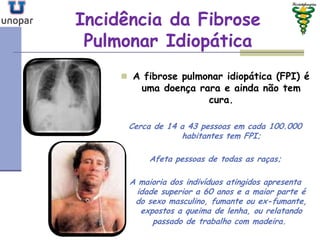 Incidência da FibroseIncidência da Fibrose
Pulmonar IdiopáticaPulmonar Idiopática
 A fibrose pulmonar idiopática (FPI) é
uma doença rara e ainda não tem
cura.
Cerca de 14 a 43 pessoas em cada 100.000
habitantes tem FPI;
Afeta pessoas de todas as raças;
A maioria dos indivíduos atingidos apresenta
idade superior a 60 anos e a maior parte é
do sexo masculino, fumante ou ex-fumante,
expostos a queima de lenha, ou relatando
passado de trabalho com madeira.
 
