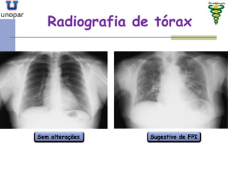 Radiografia de tóraxRadiografia de tórax
Sem alterações Sugestivo de FPI
 