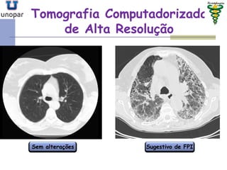 Tomografia ComputadorizadaTomografia Computadorizada
de Alta Resoluçãode Alta Resolução
Sem alterações Sugestivo de FPI
 